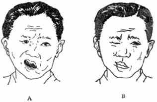 面瘫可以吃凉瓜,缓解不适